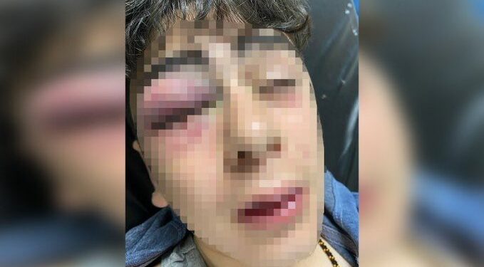 Lice’de 14 yaşında çocuğa işkence: Bir gözünü kaybetme tehlikesi var