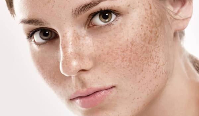 🌞Güneş Lekeleri Nasıl Geçer? İşte Etkili Yöntemler