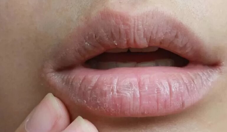 Ağız kuruluğu nedir?