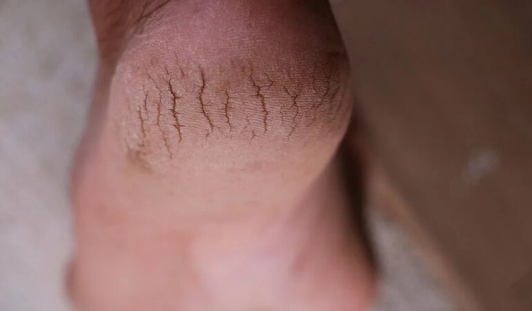 Topuk çatlaklarına derinden çözüm