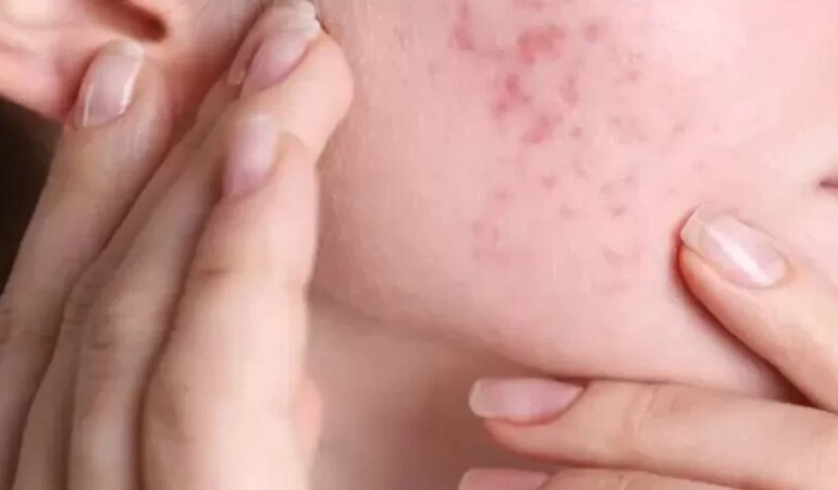 Yağlı ciltler için çay ağacı yağı