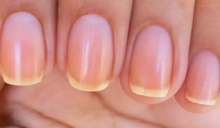 Ojeden sararan tırnaklara doğal çözüm