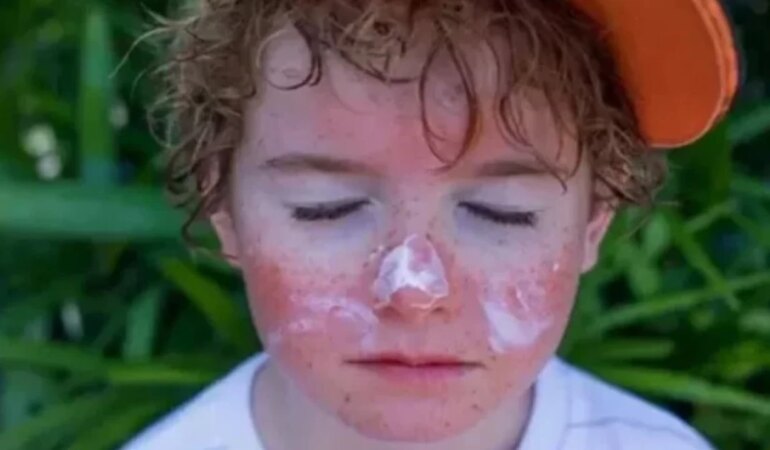 Güneş yanığına yoğurt sürülür mü?