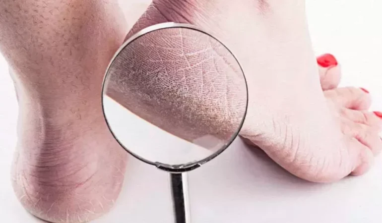 Topuk çatlakları: Neden olur ve nasıl önlenir?