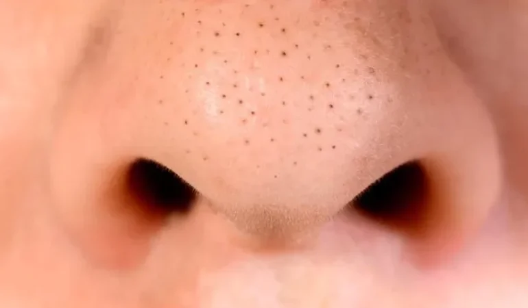 Siyah nokta temizliği nasıl yapılır?