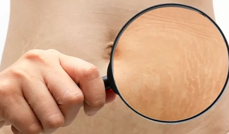 Cilt Çatlakları Nedir ve Neden Oluşur?