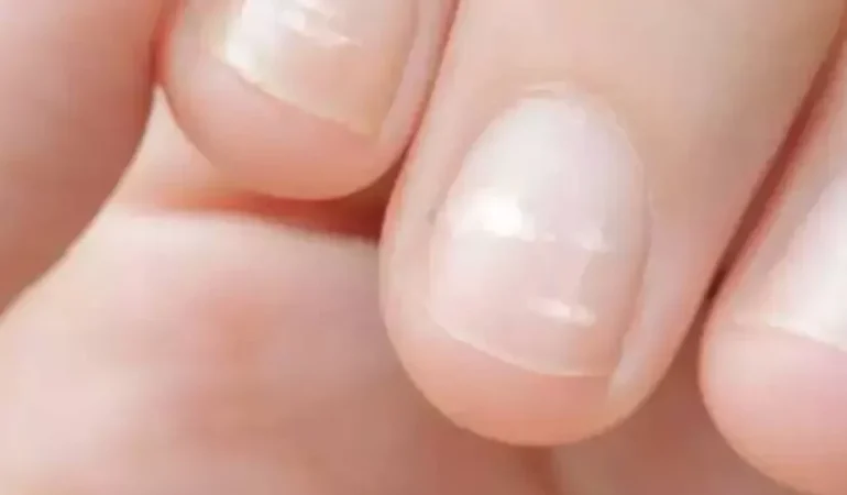 Tırnaklarda lökoniki (Beyaz leke) nasıl geçer?