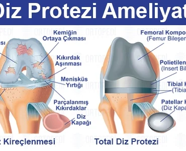 diz_protezi_ameliyati_nedir